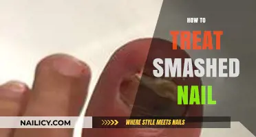 Effective Home Remedies for Treating a Smashed Nail Injury