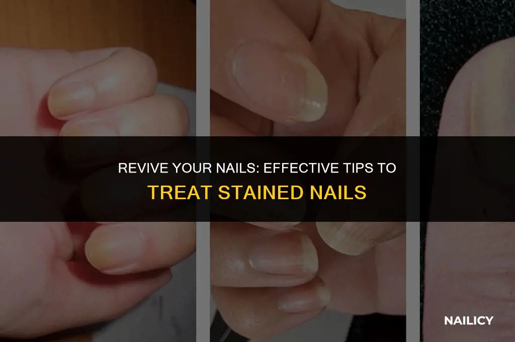 how to treat stained nails