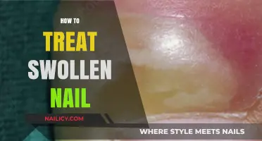 Effective Remedies for Treating a Swollen Nail at Home