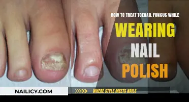 Treating Toenail Fungus: Tips for Wearing Nail Polish Safely