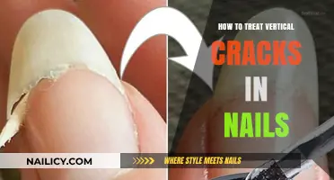 Treating Vertical Nail Cracks: Effective Remedies for Stronger, Healthier Nails