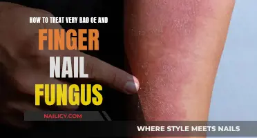Eradicate Embarrassing Nail Fungus with These Powerful Treatments