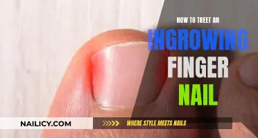 Treating Ingrown Fingernails: A Quick, Painless Guide