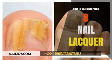 Treating Nail Fungus Effectively with Ciclopirox 8% Nail Lacquer