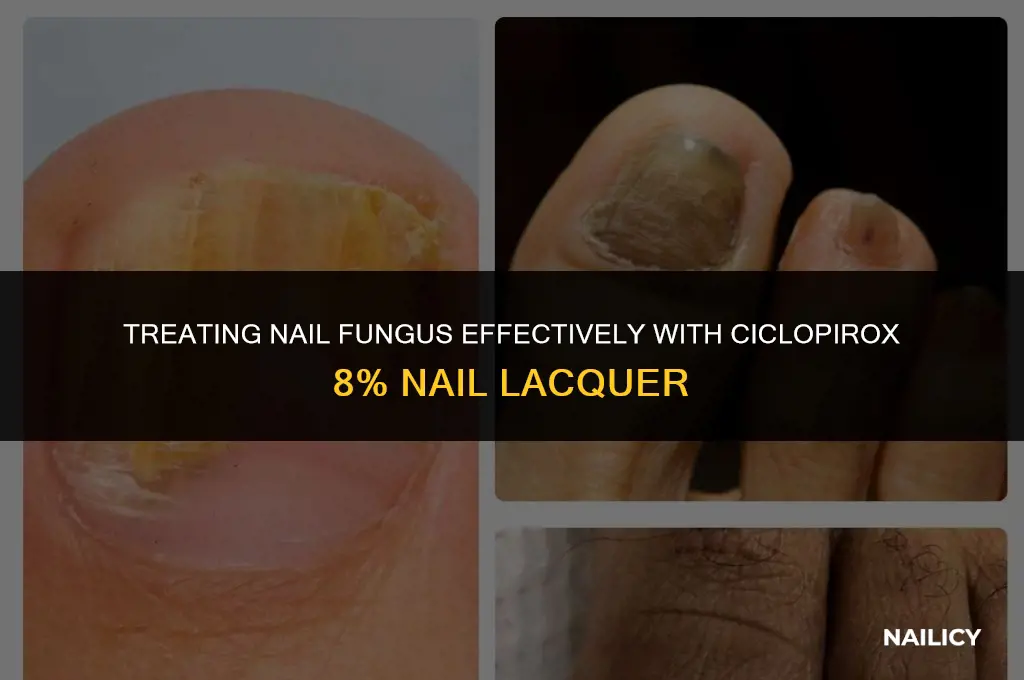 how to use ciclopirox 8 nail lacquer