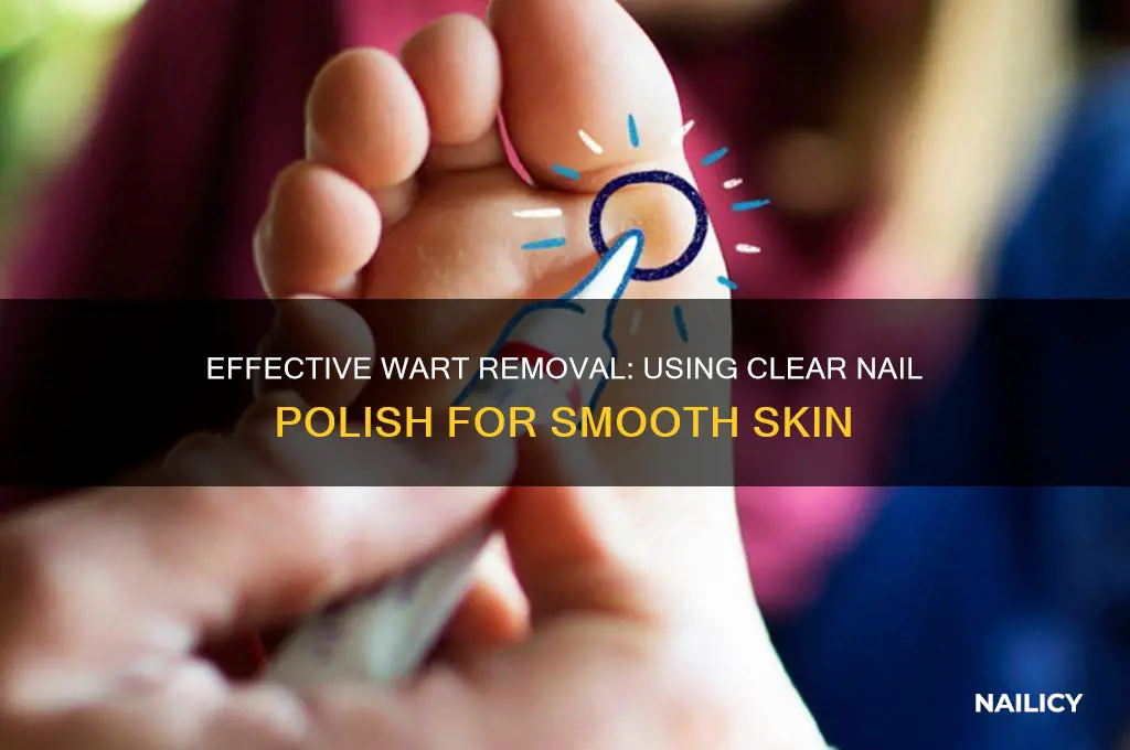 how to use clear nail polish on warts