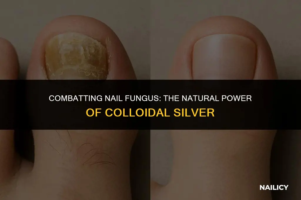 how to use colloidal silver for nail fungus