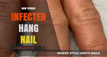 Treating an Infected Hangnail: A Step-by-Step Guide