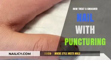Treating a Smashed Nail: The Puncturing Method Explained