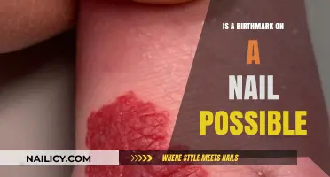 Can Birthmarks Appear on Fingernails? Unraveling the Nail Mark Mystery