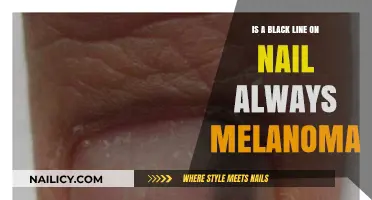 Black Line on Nail: Melanoma or Harmless? Uncover the Truth