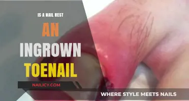 Nail Rest for Ingrown Toenails: Effective Solution or Temporary Relief?