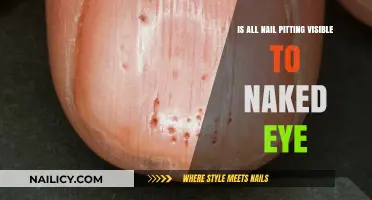 Can You Spot All Nail Pitting Without a Magnifying Glass?