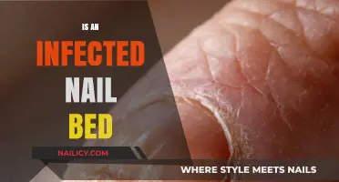 Understanding and Treating an Infected Nail Bed: A Comprehensive Guide