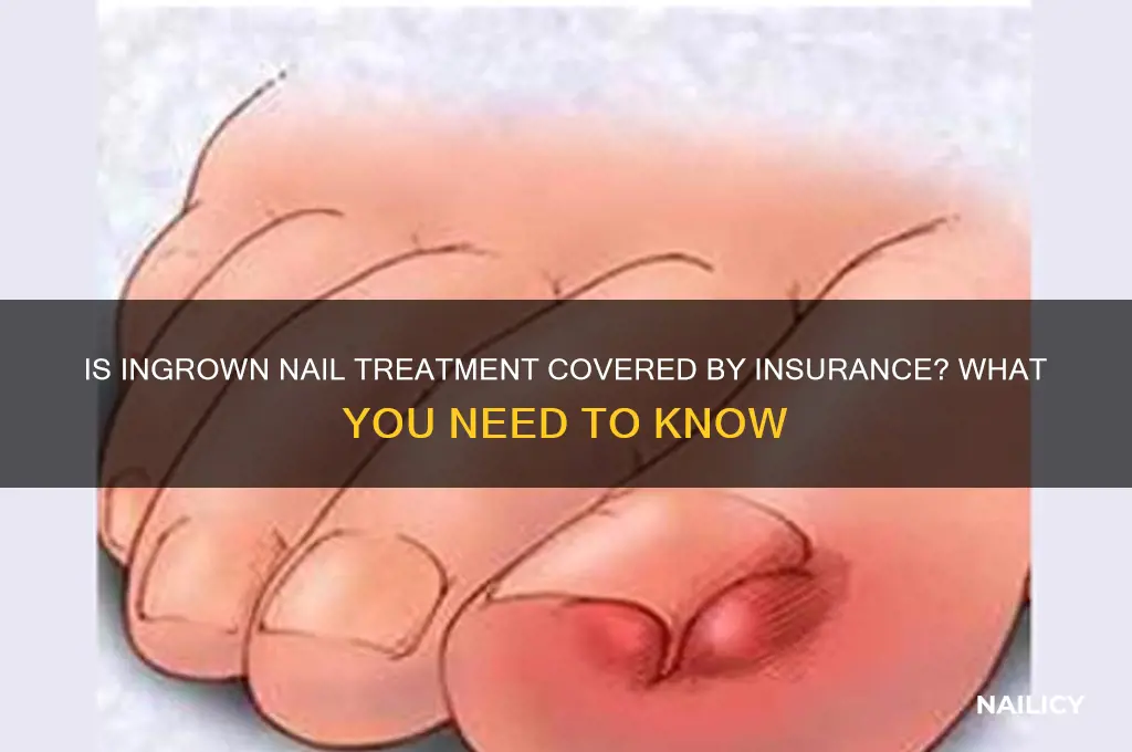 is an ingrown nail covered by insurance