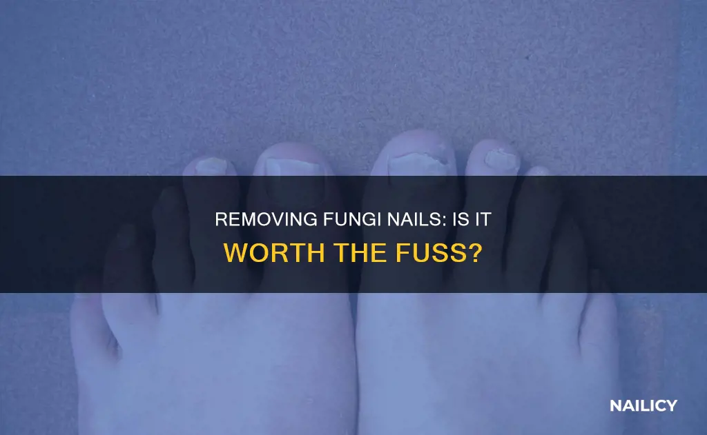 is better to remove a fungi nail