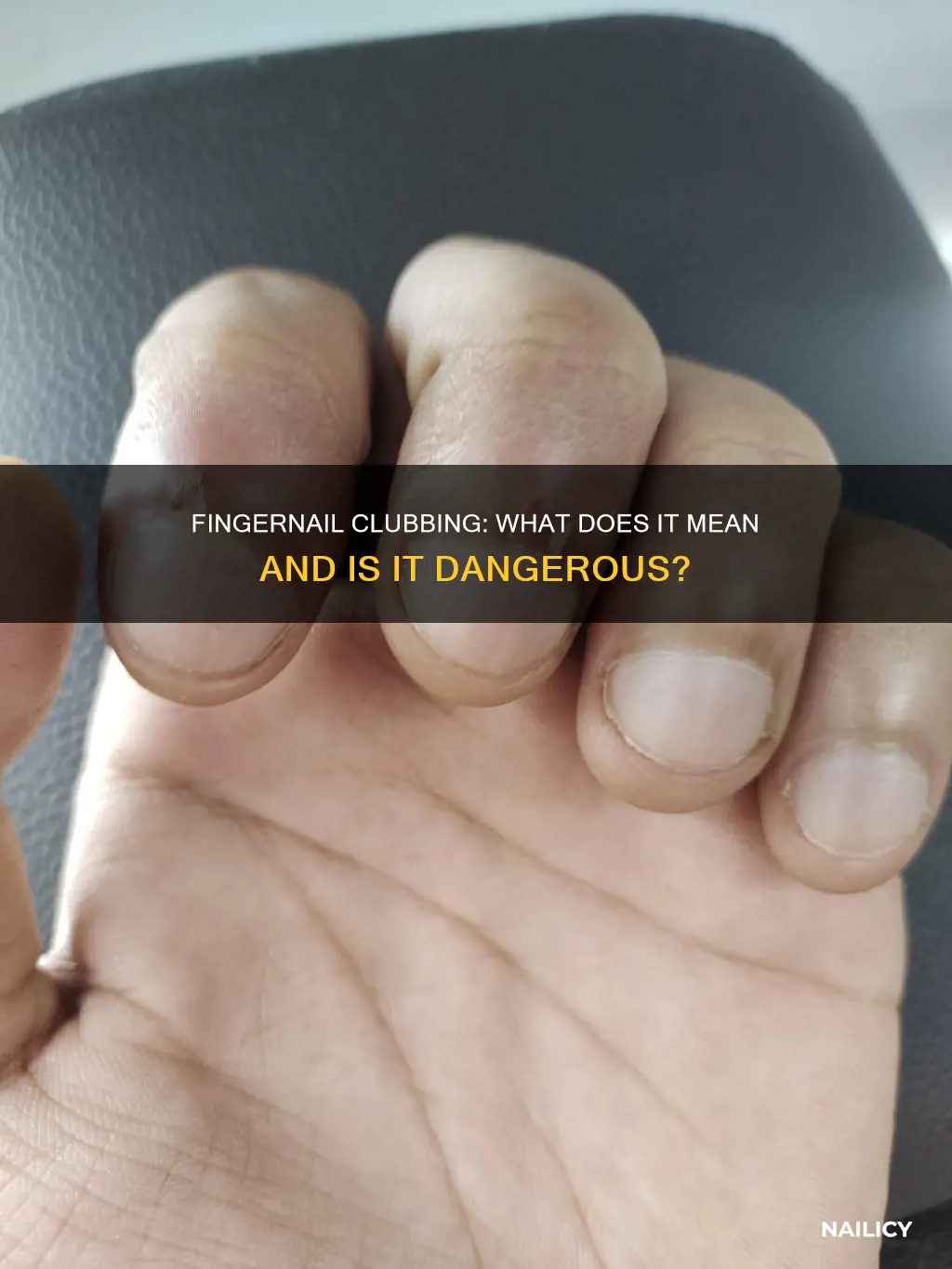 is finger nail clubbing always bad