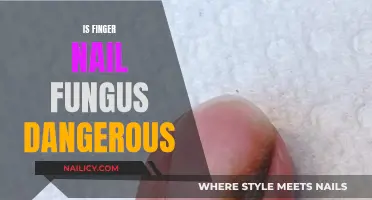 Fingernail Fungus: Is It a Dangerous Health Concern?