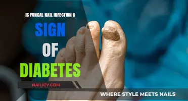 Fungal Nail Infections: A Potential Indicator of Diabetes?