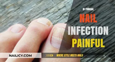 Understanding Fungal Nail Infections: Causes, Symptoms, and Treatments