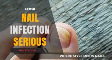Unveiling the Truth: How Serious is a Fungal Nail Infection?