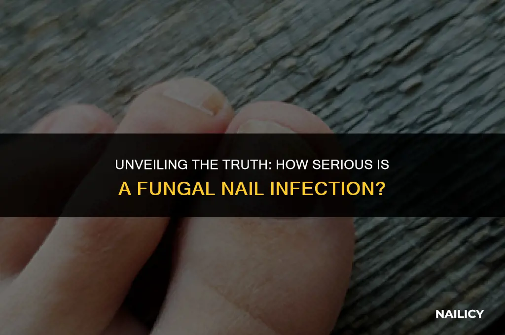 is fungal nail infection serious