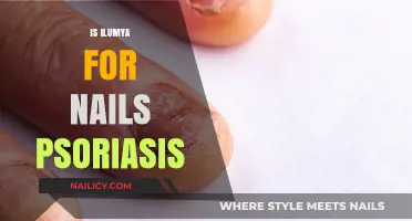 Exploring Ilumya: A Potential Solution for Nail Psoriasis