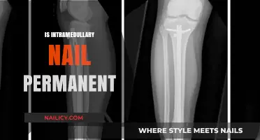 Exploring the Longevity of Intramedullary Nails: Are They Permanent?