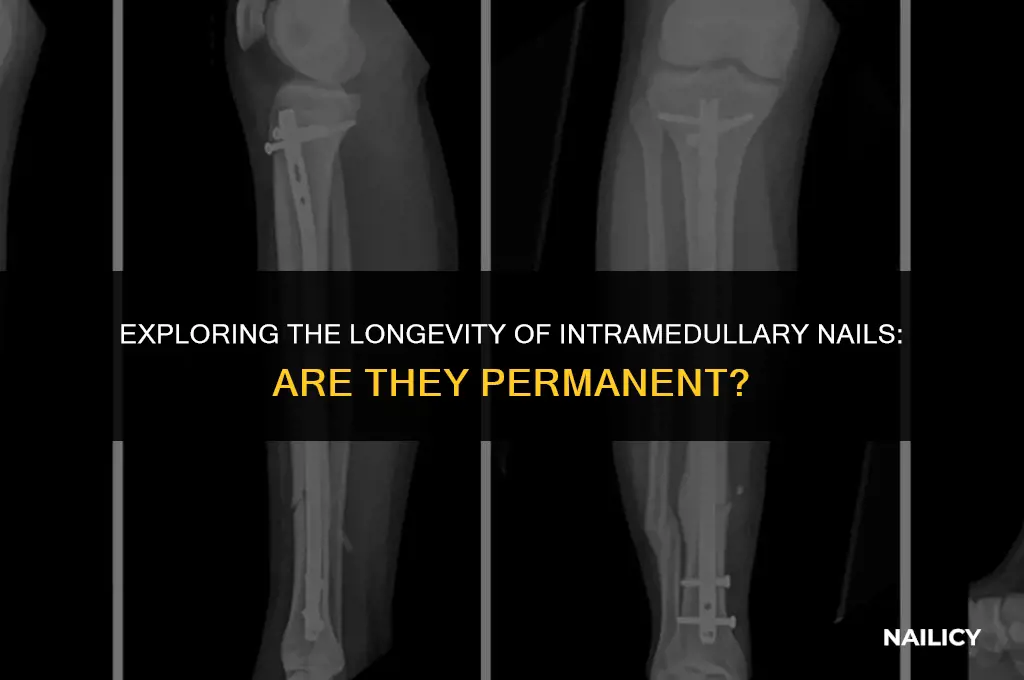 is intramedullary nail permanent