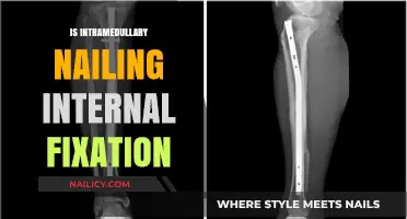 Exploring Intramedullary Nailing: A Comprehensive Guide to Internal Fixation