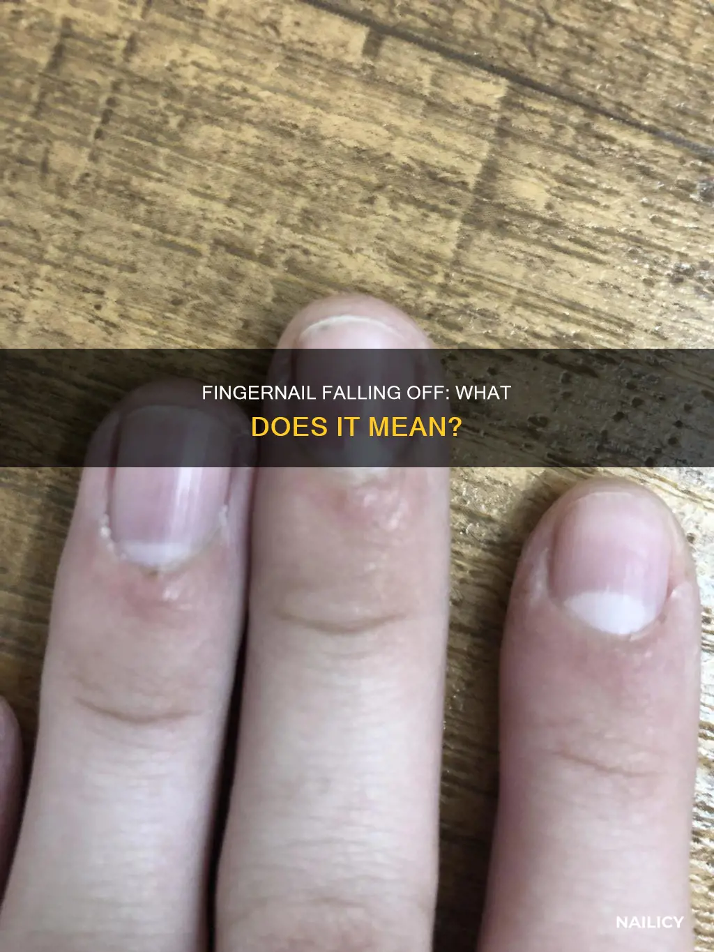 is it bad for your finger nail to fall off