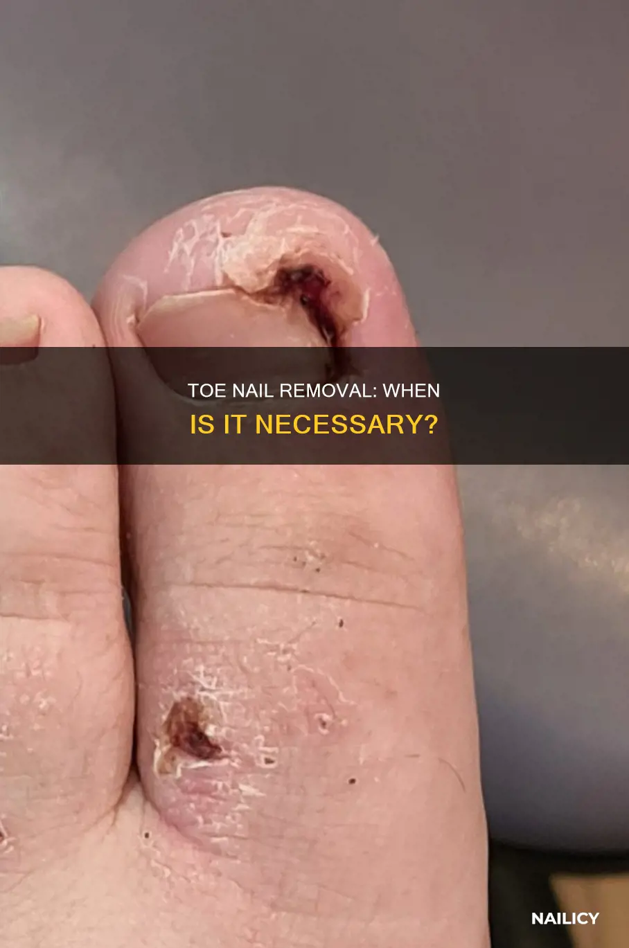 is it better to remove a damaged toe nail