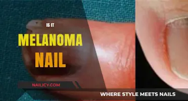 Unveiling the Truth: Is That Nail Discoloration a Sign of Melanoma?
