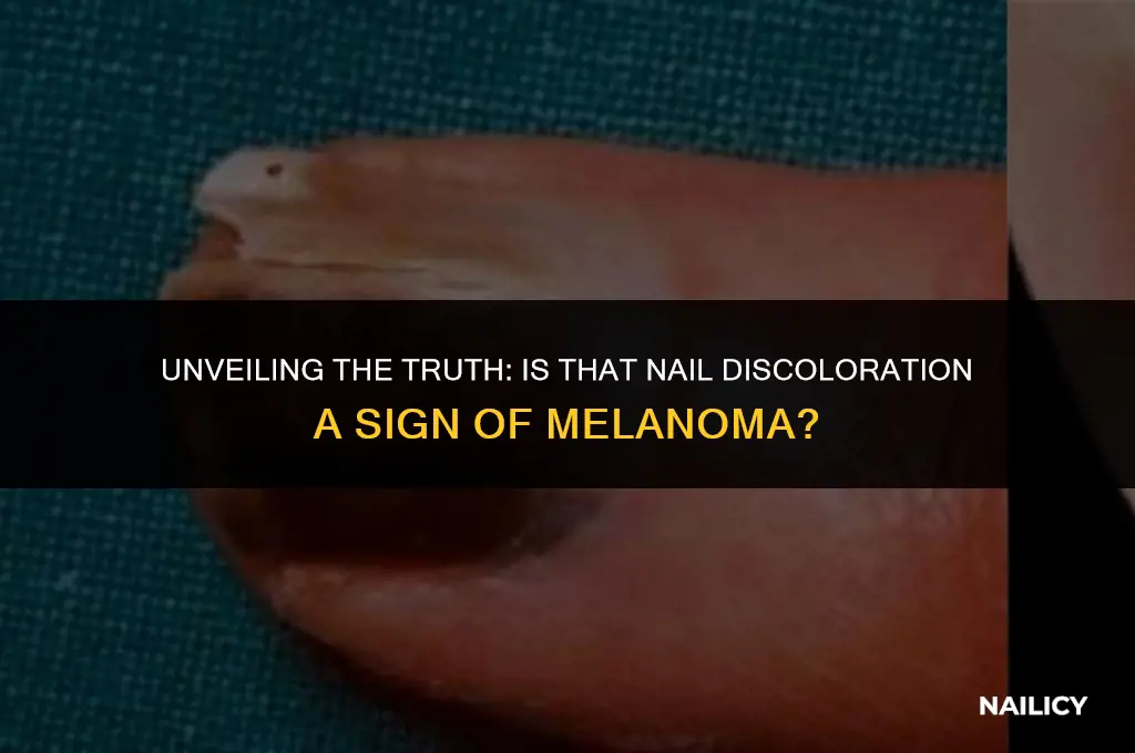 is it melanoma nail