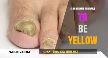Why Are My Nails Yellow? Causes and Solutions Explained