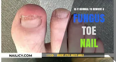 Toe Fungus: Should You Remove That Nail?