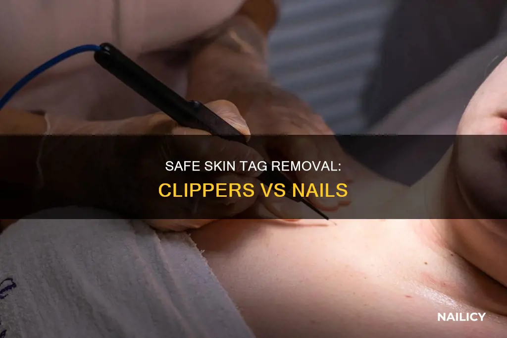 is it safe to remove skin tags with nail clippers