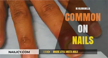 Unveiling the Truth: Klebsiella's Presence on Nails Explored