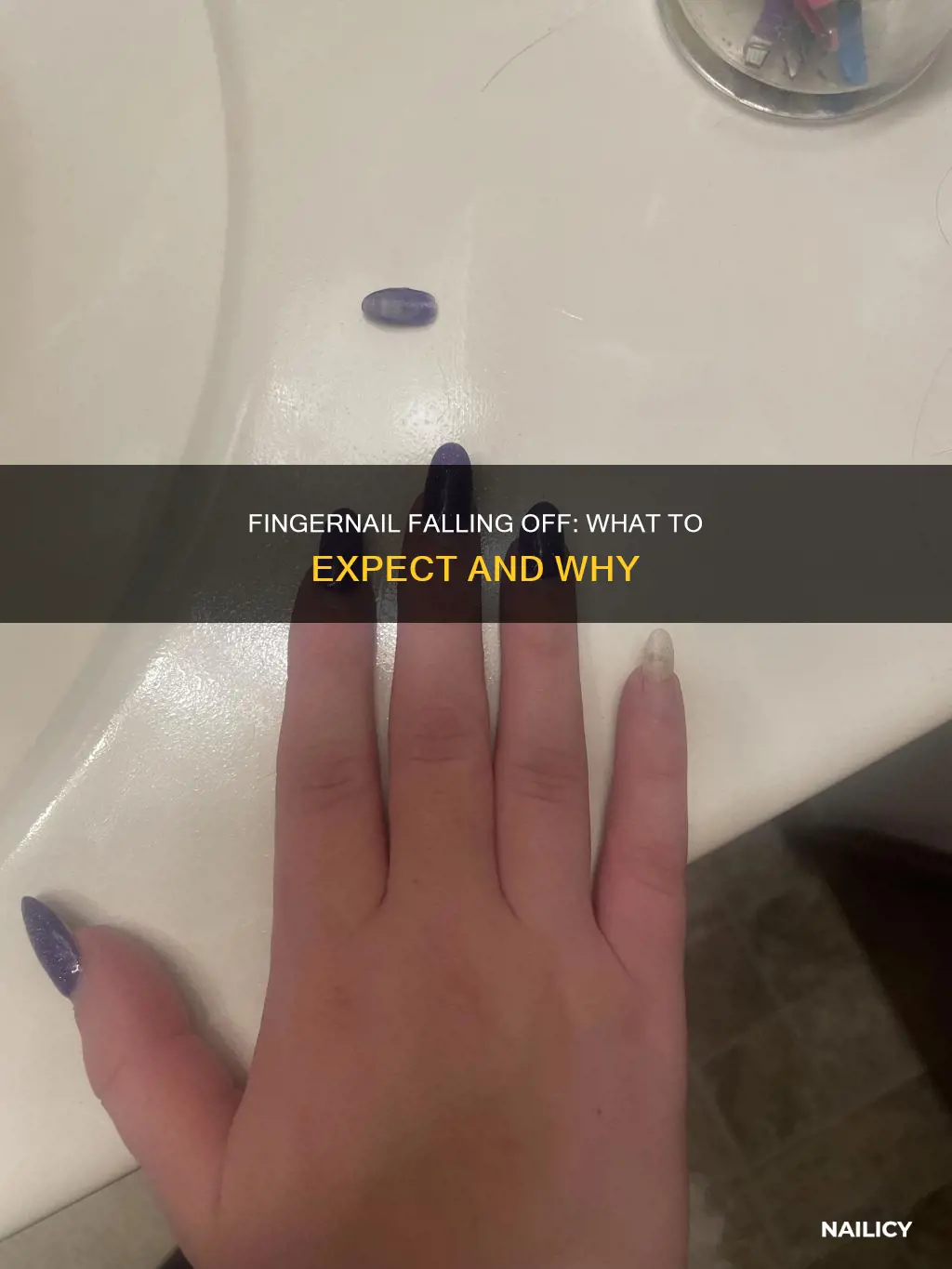 is my finger nail going to fall off