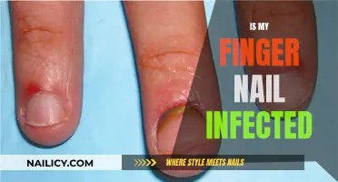 Identifying Nail Infection: What You Need to Know