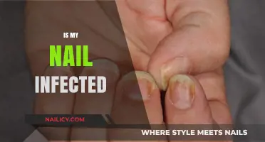 Is My Nail Infected? Signs, Symptoms, and When to Seek Help