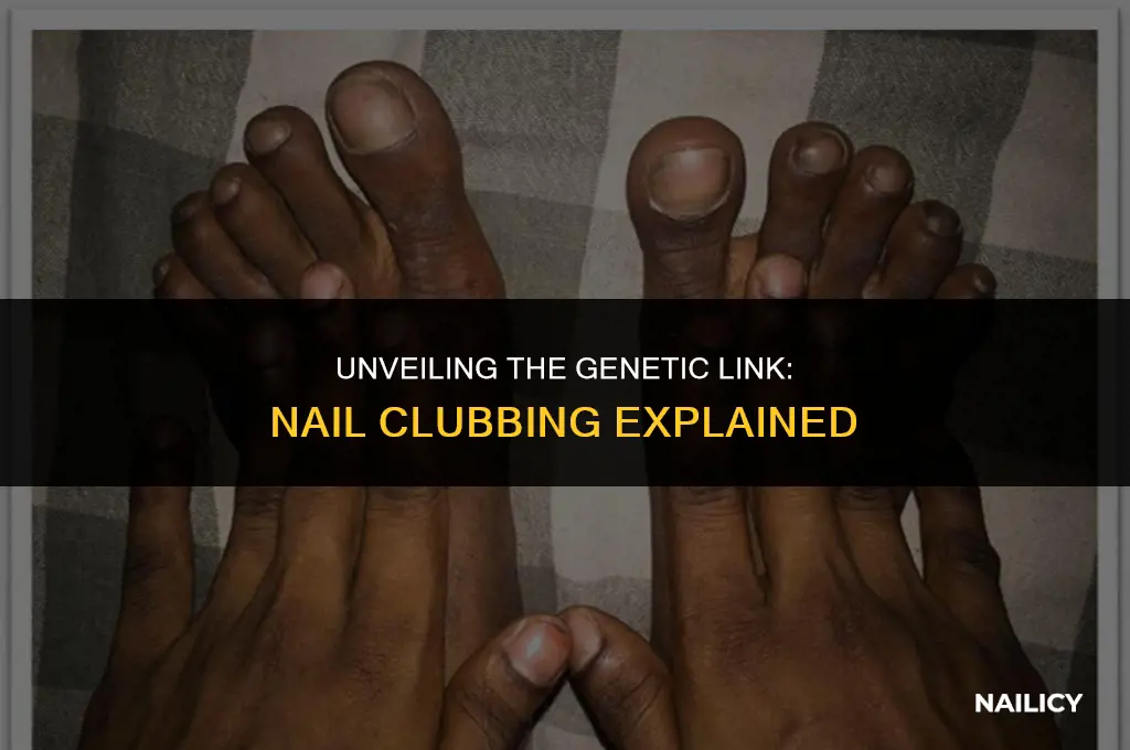 is nail clubbing genetic