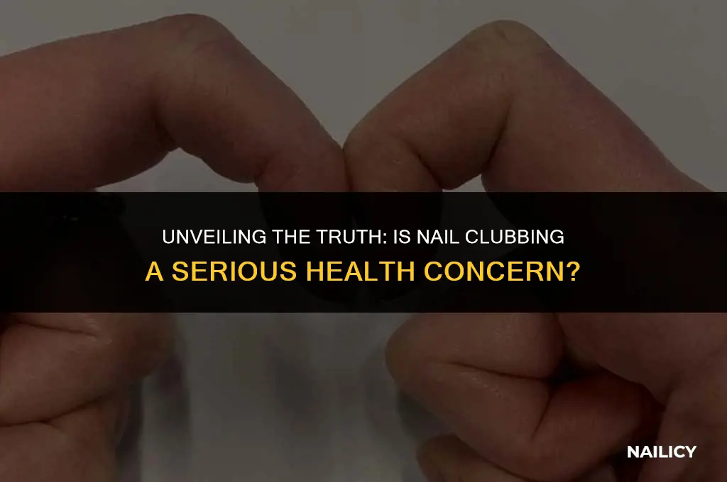 is nail clubbing serious