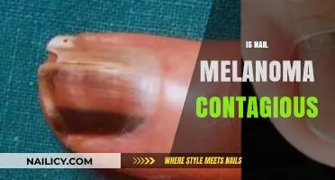 Understanding Nail Melanoma: Is It Contagious and What Are the Risks?
