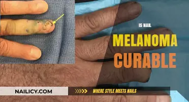 Hope and Healing: The Journey to Curing Nail Melanoma