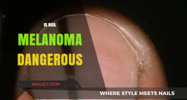 Unveiling the Truth: Is Nail Melanoma a Silent Threat?