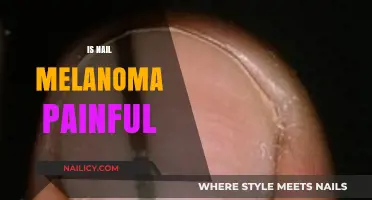 Understanding Nail Melanoma: Symptoms, Diagnosis, and Treatment Options