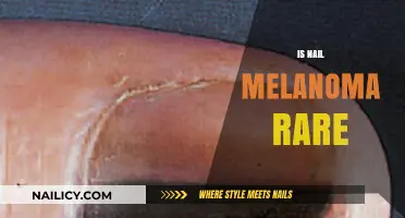 Unveiling the Truth: Is Nail Melanoma Truly Rare?