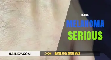 Unveiling the Truth: Is Nail Melanoma a Serious Concern?