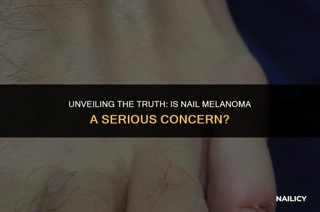 is nail melanoma serious